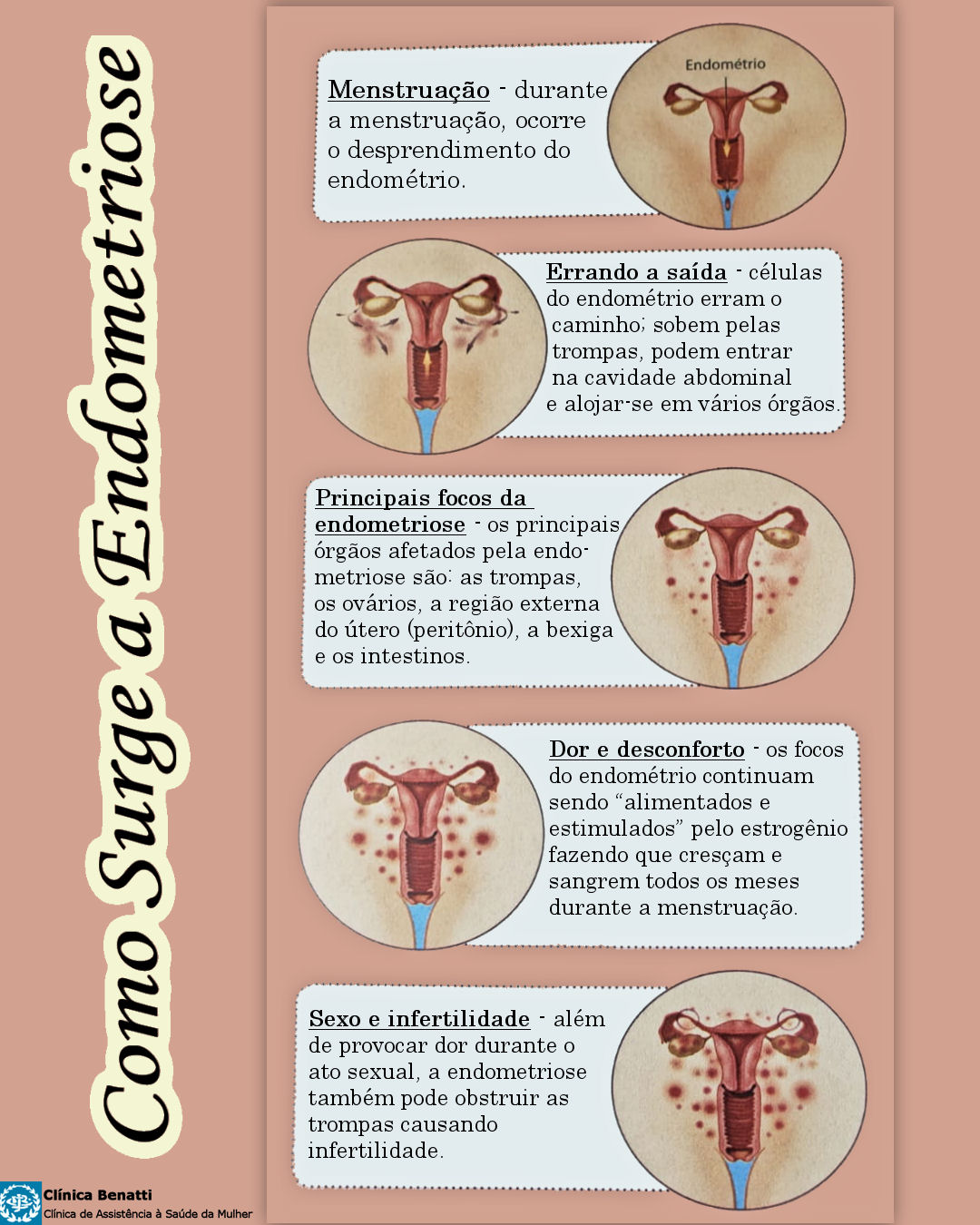 Como surge a Endometriose