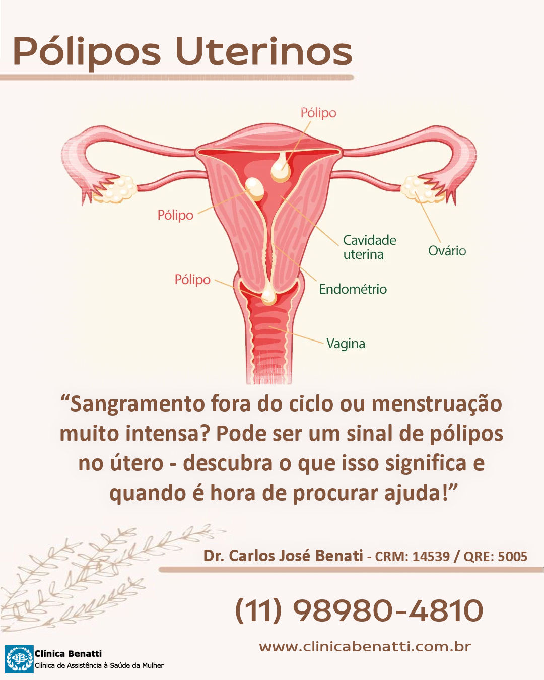 Você sabe o que são Pólipos no Útero? Descubra tudo agora!